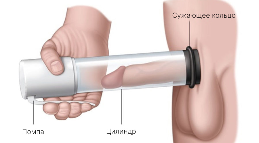 vakuumnyy-metod-lecheniya-erektilnoy-disfunkcii.jpg